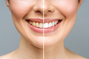como prolongar el blanqueamiento dental