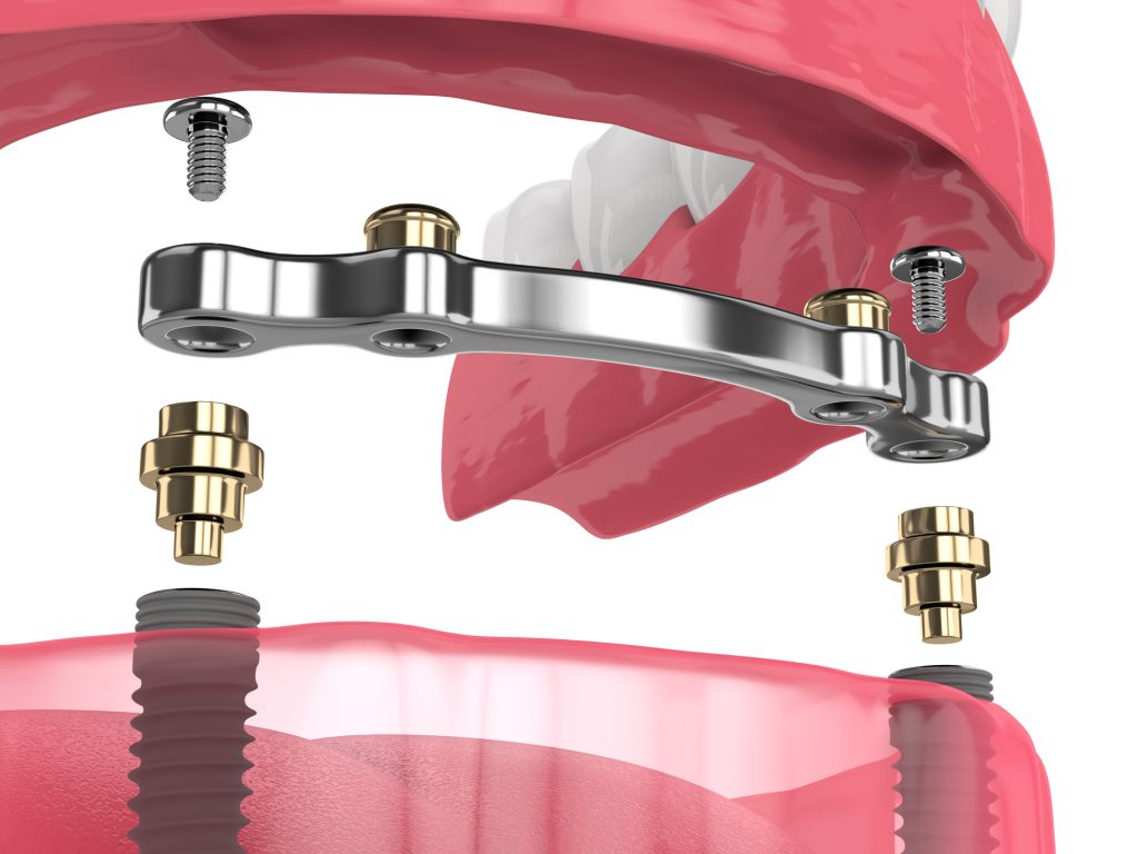 sobredentadura sobre implantes