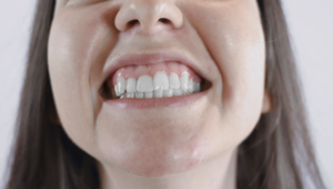 revisando la mordida después de realizar un empaste dental